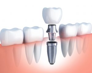 3D illustration of a single-tooth dental implant with crown