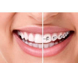 Before-and-after comparison of orthodontic treatment